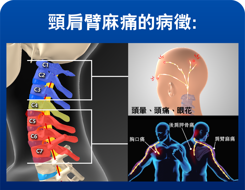 頸椎神經受壓