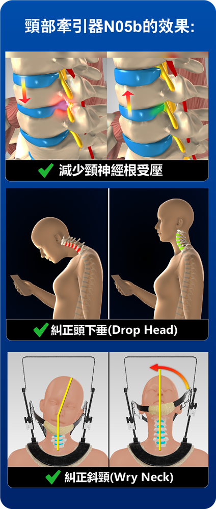 頸椎神經受壓