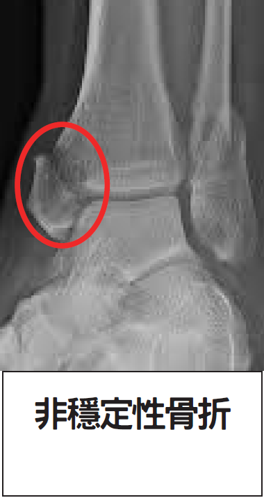 足踝骨折