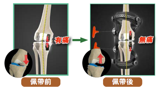 K39d 膝矯形器以三點力學協助負重的原理
